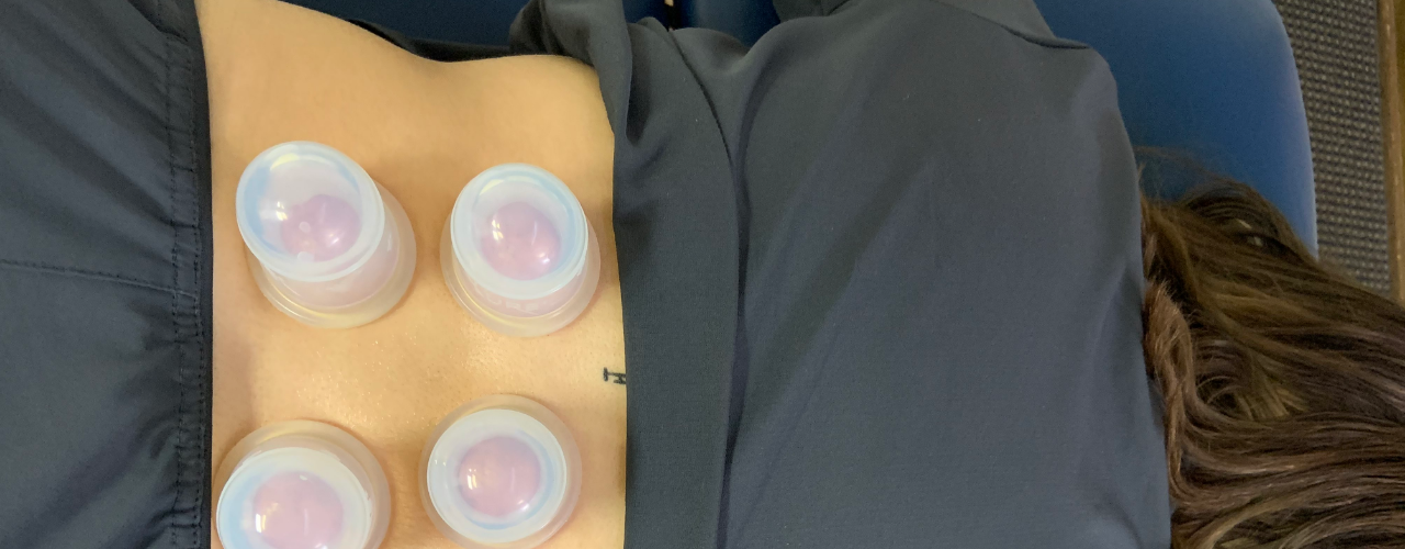 Cupping Boulet PT and Wellness