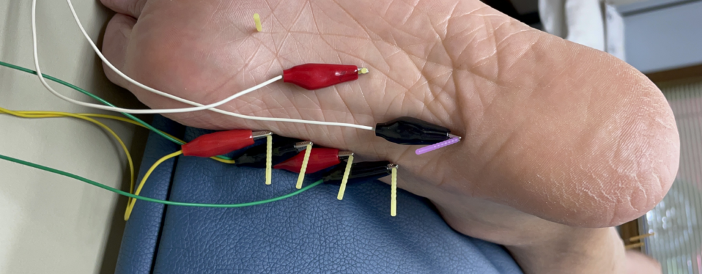 dry-needling-boulet-physical-therapy-and-wellness-lafayette-la