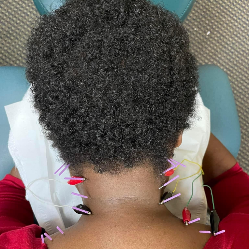 dry-needling-boulet-physical-therapy-and-wellness-lafayette-la