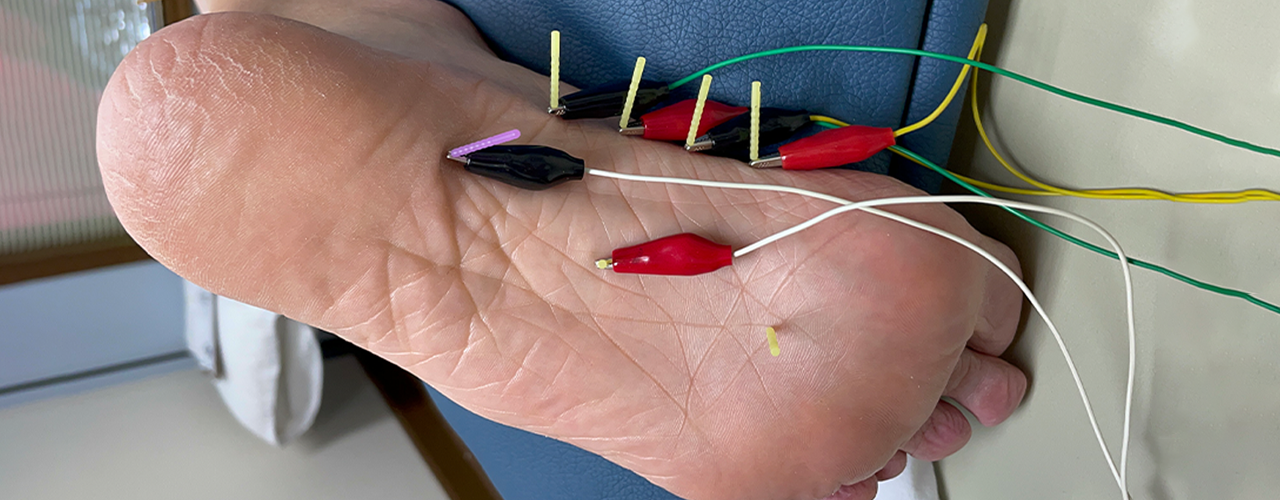 dry-needling-boulet-physical-therapy-wellness-lafayette-la